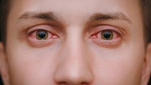 Allergic Conjunctivitis