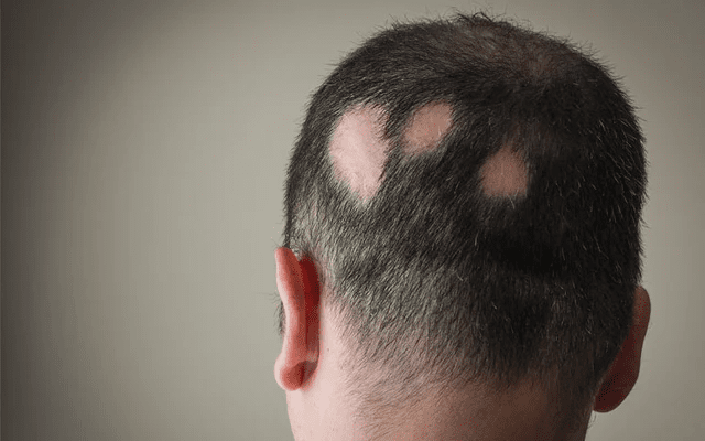 Alopecia Treatments