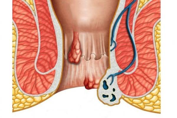 Homeopathy Treatment forAnal fissure Treatment In Kurnool