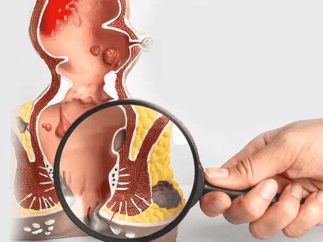 Homeopathy Treatment for Anal Fistula Treatment In Kurnool