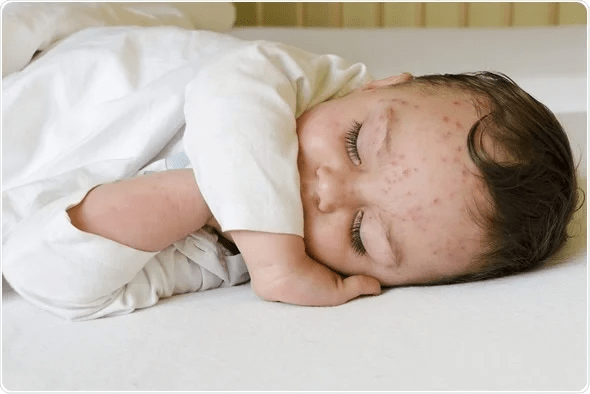 Skin Infection In Children