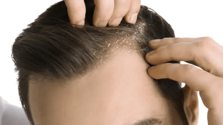 Homeopathy Treatment for Dandruff In Kurnool