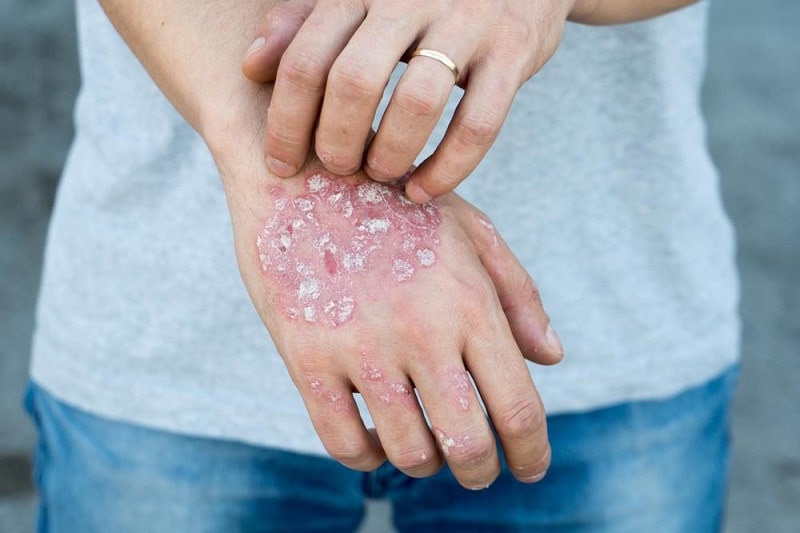 Eczema Treatments