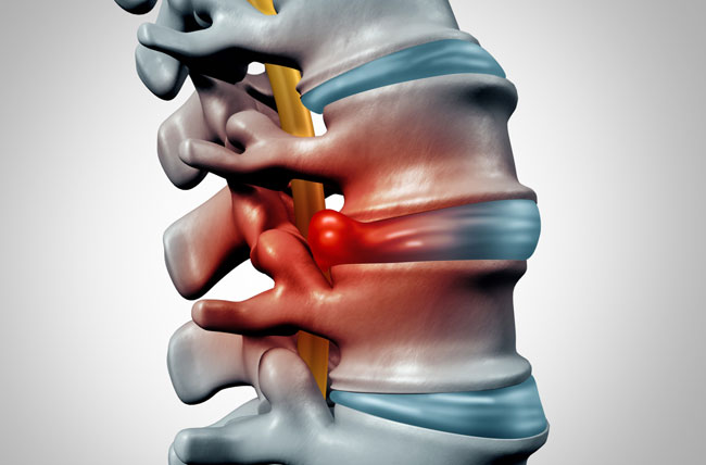 Homeopathy Treatment for Disc Bulges In Kurnool