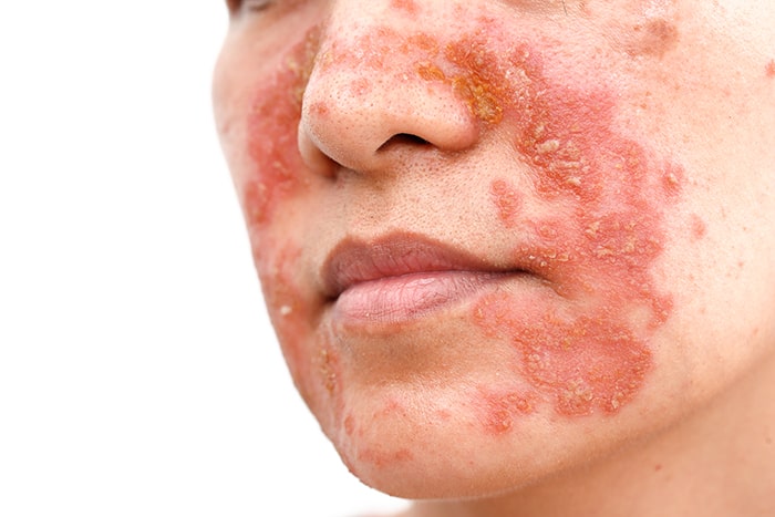 Homeopathy Treatment for Dermatitis In Kurnool