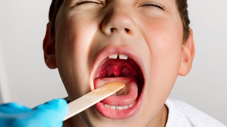 Homeopathy Treatment for Tonsillitis In Kurnool