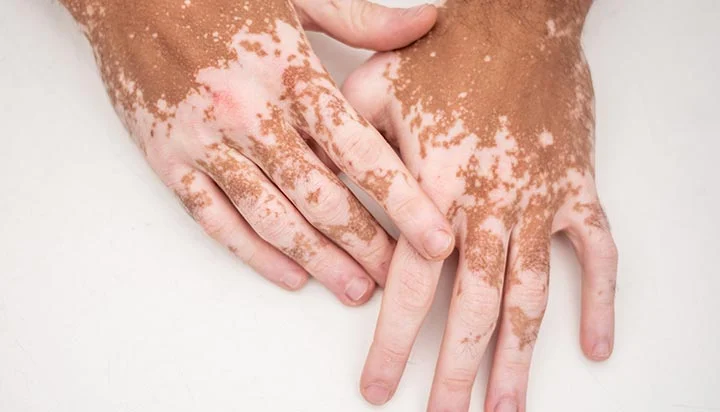 Homeopathy Treatment for Vitiligo In Kurnool